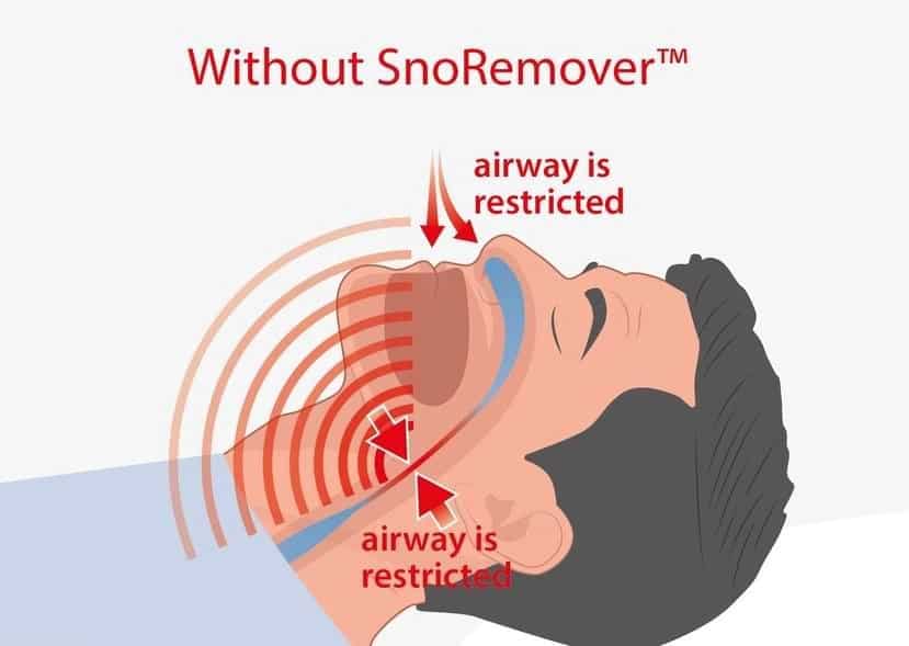 What causes snoring? - Snore Doc