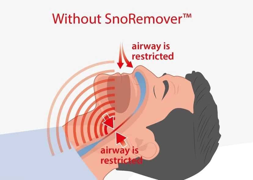 Without-SnoRemover™-Stop-Snoring-Anti-Snoring-Device